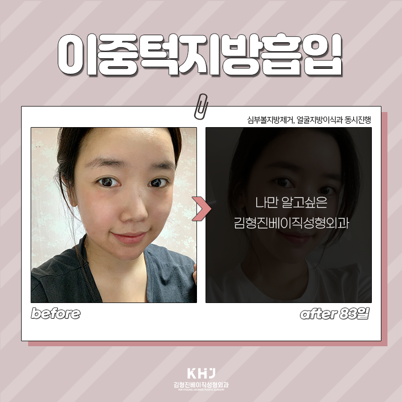 턱살빼는법 어렵지 않아요! 관련 이미지 5