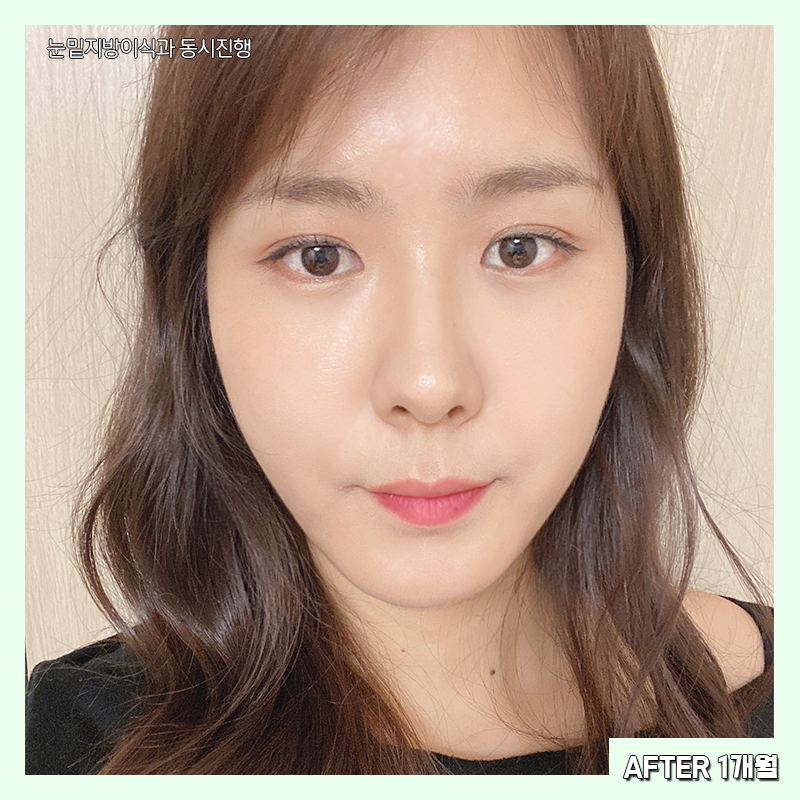 눈밑지방재배치전후 확인하고 가세요~! 관련 이미지 6