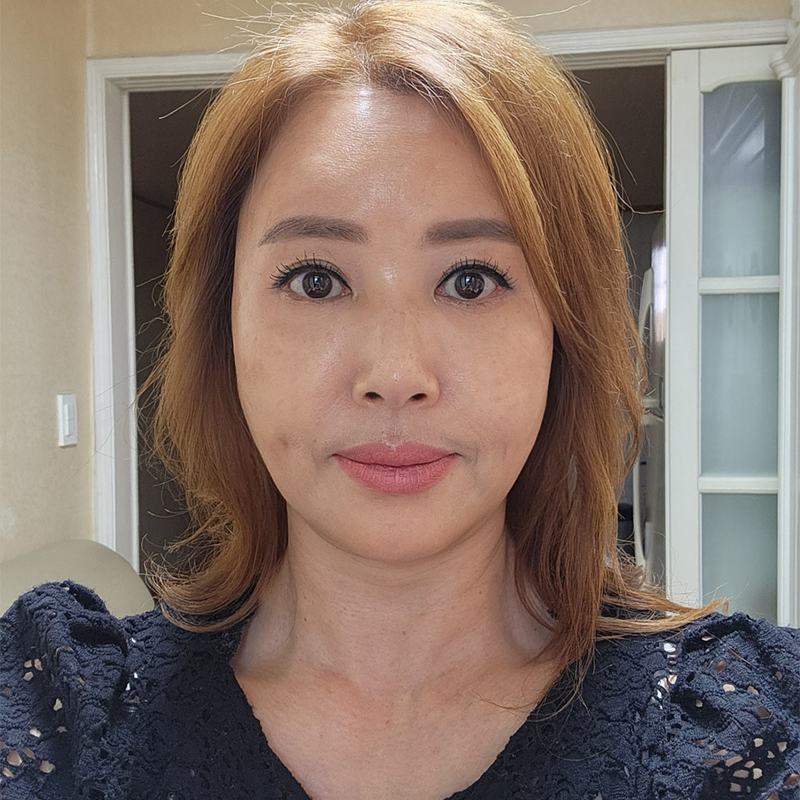 중년눈밑수술 김형진베이직에서 해야 하는 이유 관련 이미지 1