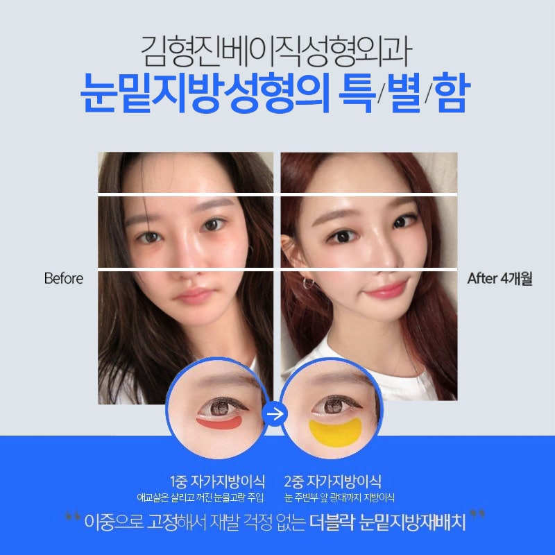 Why I Never Had to Go Back After Lower Eyelid Fat Removal image 5