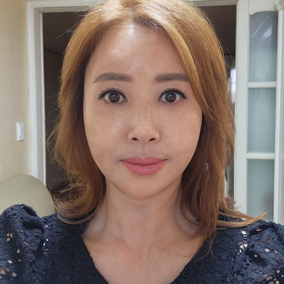 눈 밑 처짐, 미니하안검수술로 이제 가볍게 해결해요 관련 이미지 2