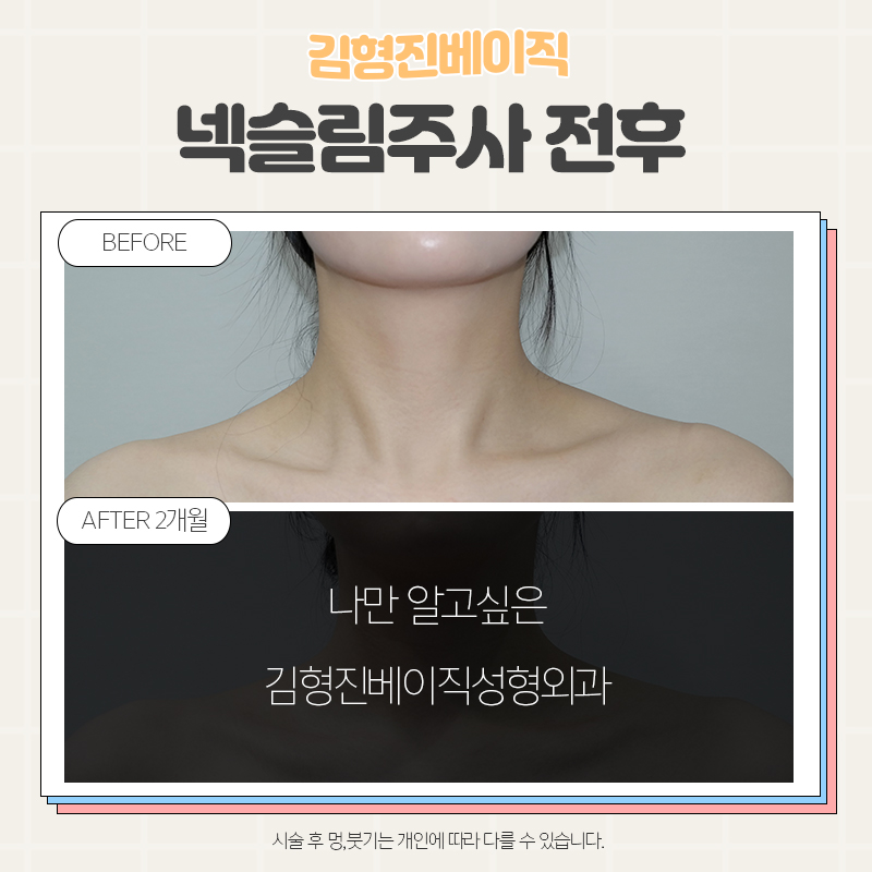 목보톡스전후 궁금하셨다면 여기로! 관련 이미지 4