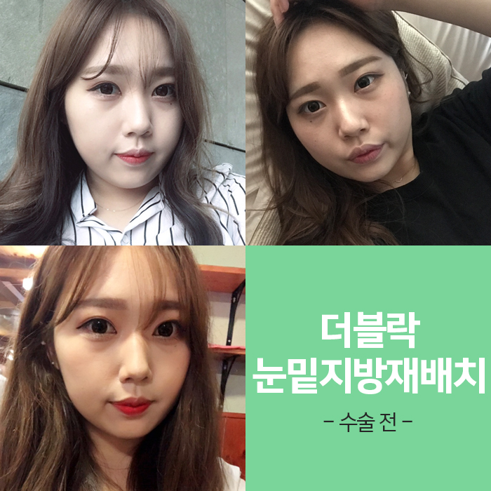 눈밑지방재배치멍 걱정? 김형진원장이라면 관련 이미지 2