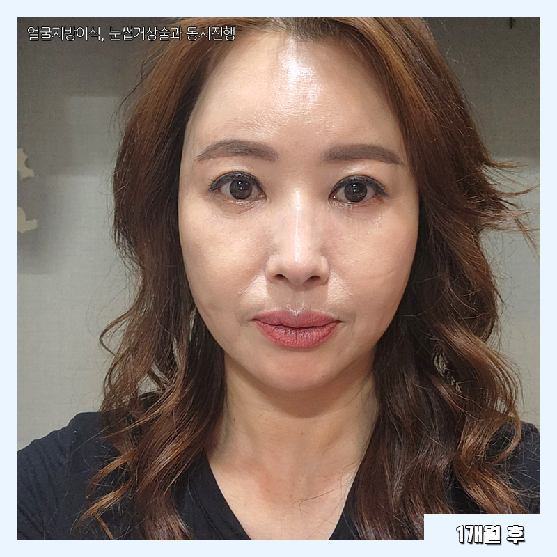 미니하안검효과 이렇게나 좋다구요! 관련 이미지 4