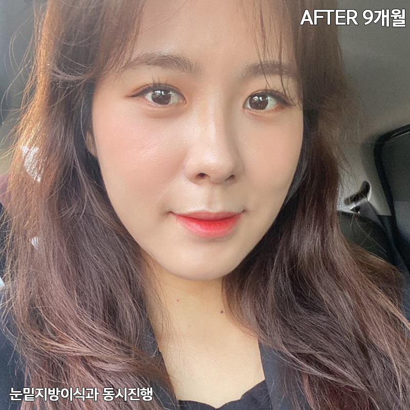눈밑지방재배치유지력 하면 김형진베이직 관련 이미지 7