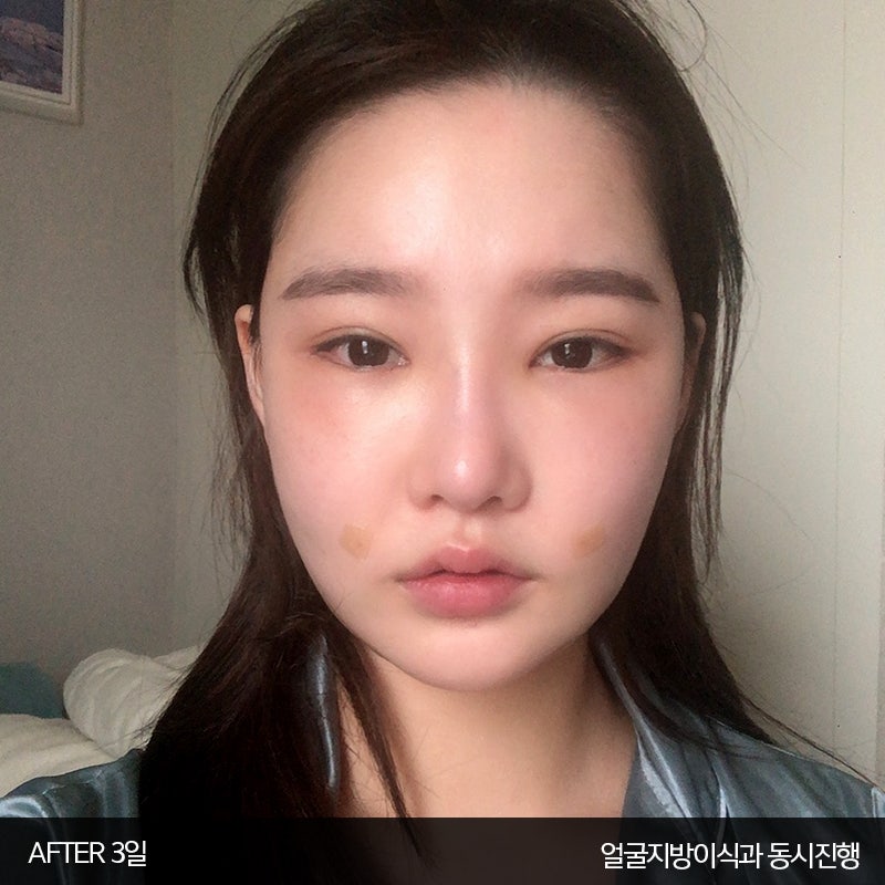 얼굴지흡붓기 김형진베이직은 달라요 관련 이미지 3
