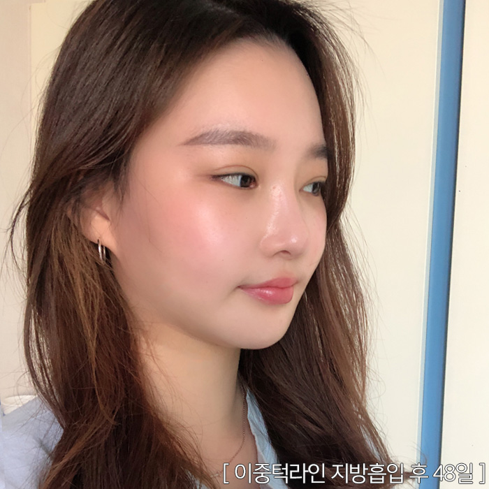 턱지방분해주사 효과 못 보지 않았어요? 관련 이미지 3