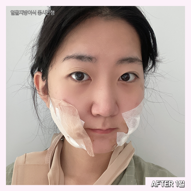 얼굴지방흡입효과 제대로 보려면 관련 이미지 3