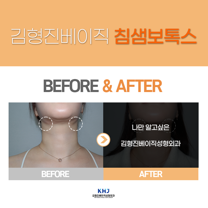 턱밑침샘보톡스효과 확인하고 가세요! 관련 이미지 3