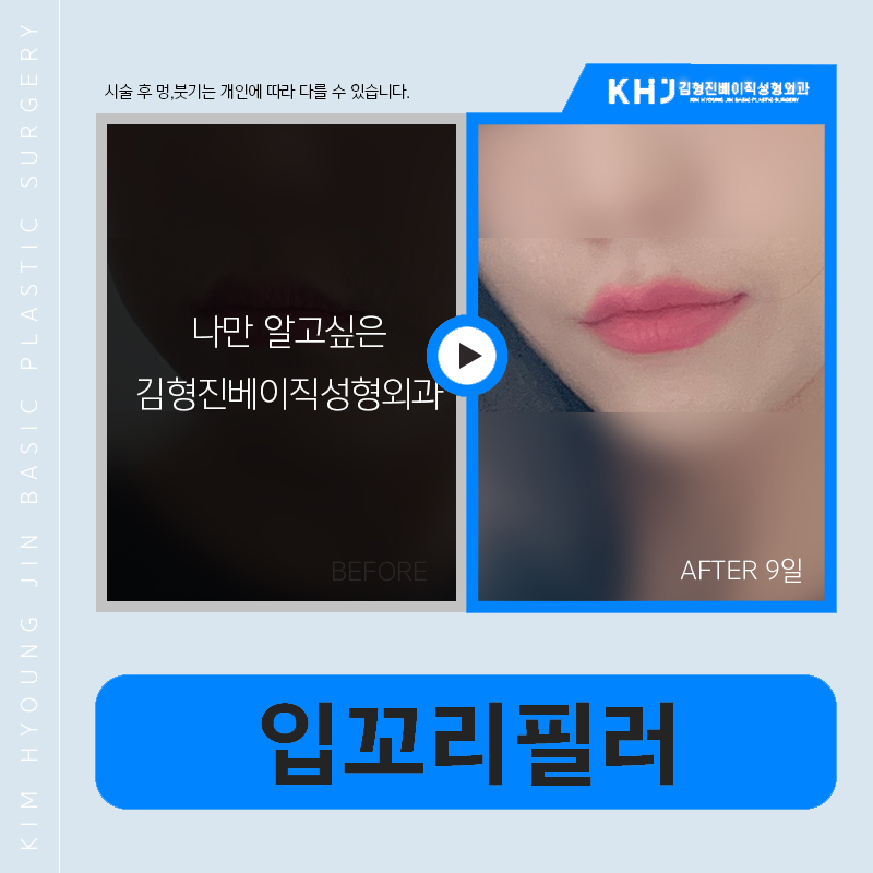 If you’re worried about asymmetrical mouth corners, this alone is enough image 6