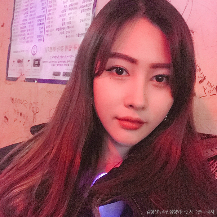 얼굴전체지방흡입 리얼후기 공개 관련 이미지 1
