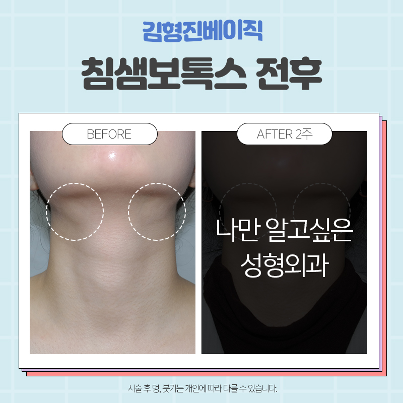 침샘보톡스전후 확실한곳, 김형진베이직 관련 이미지 4