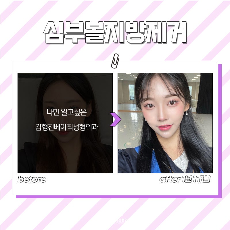 압구정심부볼제거는 김형진베이직에서 해야 하는 이유! 관련 이미지 6