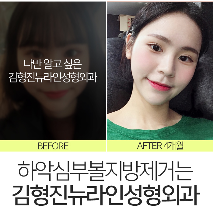 하악심부볼지방제거 잘하는곳에서 해야죠 관련 이미지 7