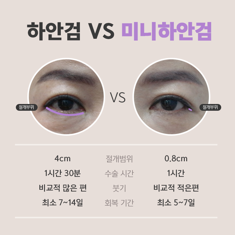 중년눈밑처짐수술 미니하안검으로 동안 인상 완성했어요! 관련 이미지 3