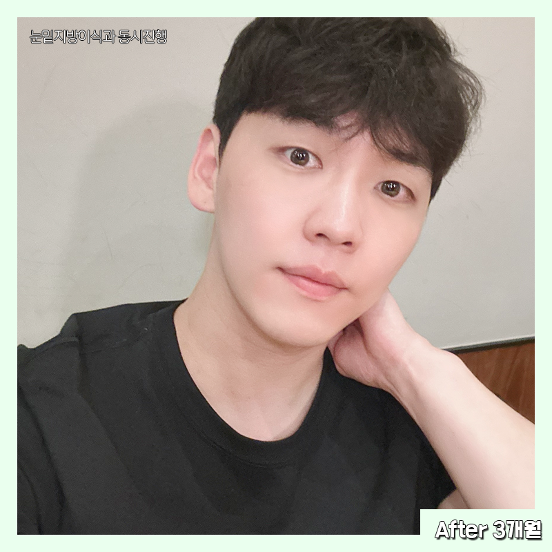 눈밑지방재배치유지력 오래가는 곳 찾으셨다면 관련 이미지 6