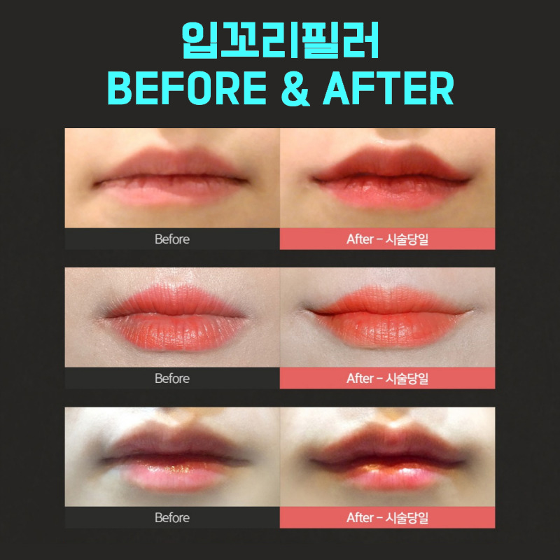 입꼬리시술로 자연스러운 미소라인 만드는 법 관련 이미지 6