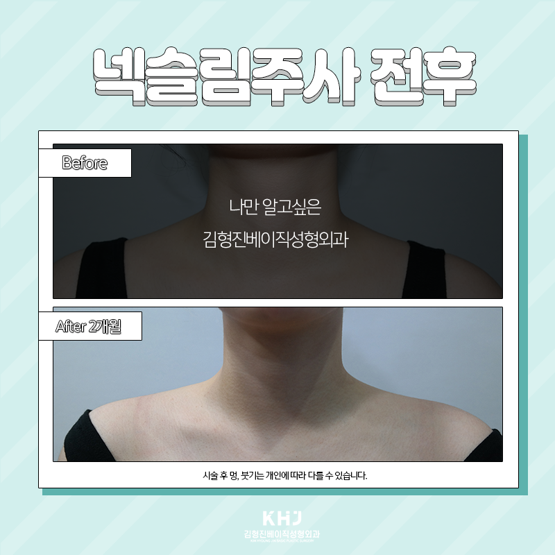 두꺼운목 고민은 이제 그만~! 관련 이미지 4