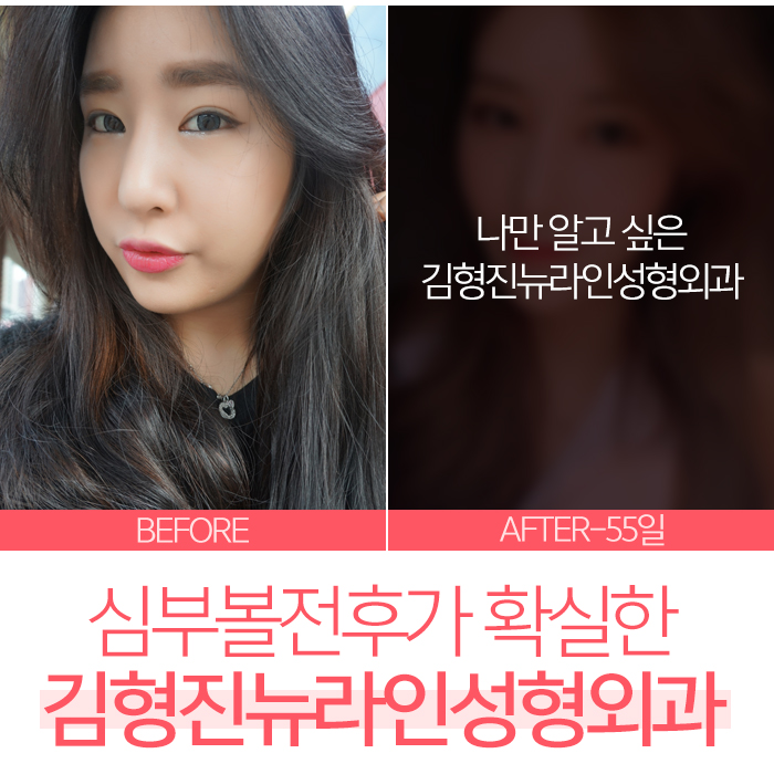 심부볼제거전후 김형진뉴라인성형외과에서 관련 이미지 1