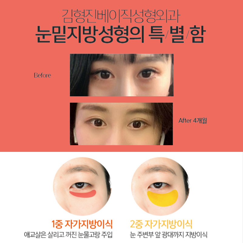 눈 밑 꺼짐 없이 어려보이는 눈밑지방없애는방법 관련 이미지 4