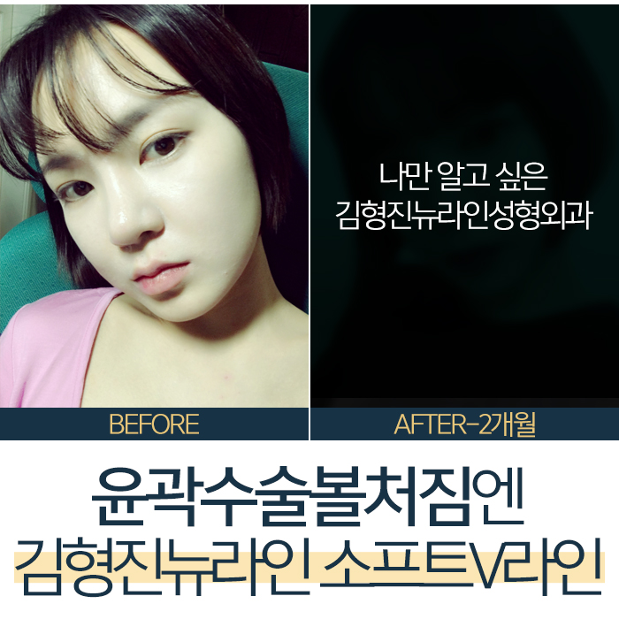 안면윤곽후볼처짐리프팅 아니야 관련 이미지 7
