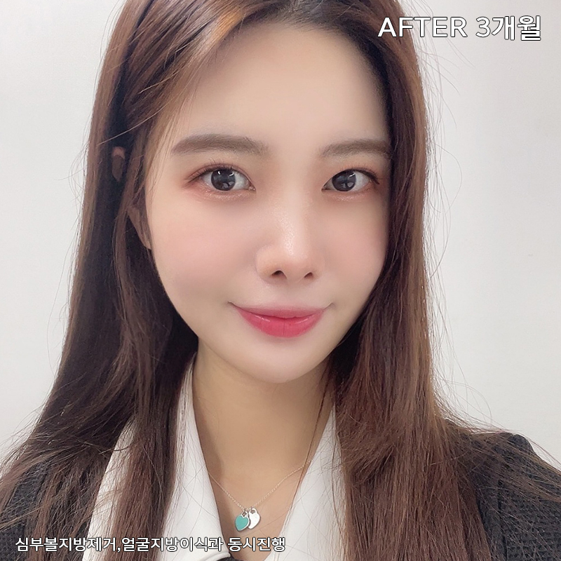 얼굴살제거 방법? 바로 알려드릴게요! 관련 이미지 7