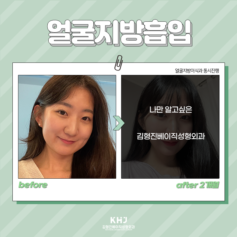 얼굴지방흡입전후 이렇게나 좋다구? 관련 이미지 5