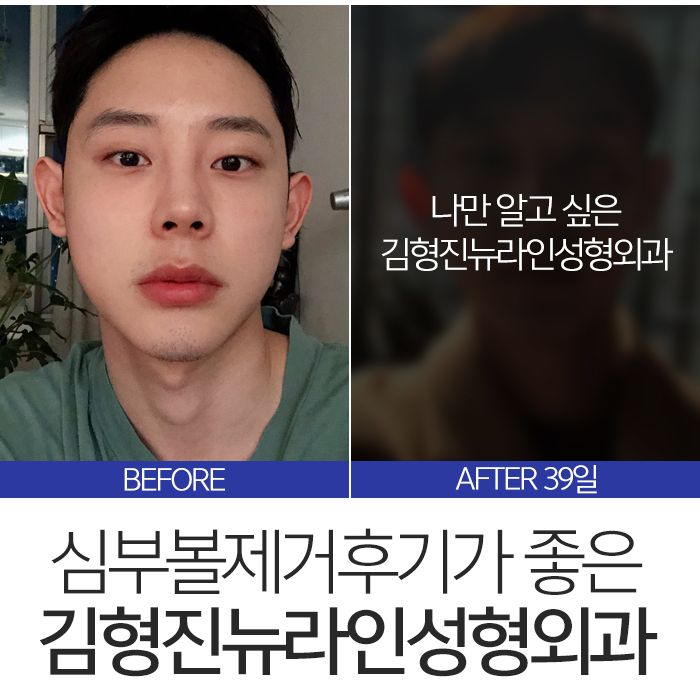 심부볼제거후기 좋을 수 밖에 없는 관련 이미지 3