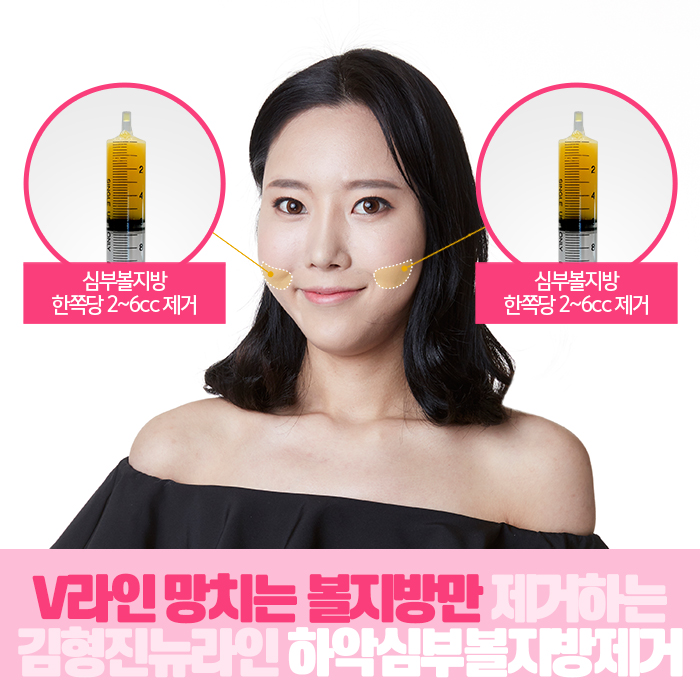 심부볼지방제거성형외과 김형진뉴라인, 알죠? 관련 이미지 6