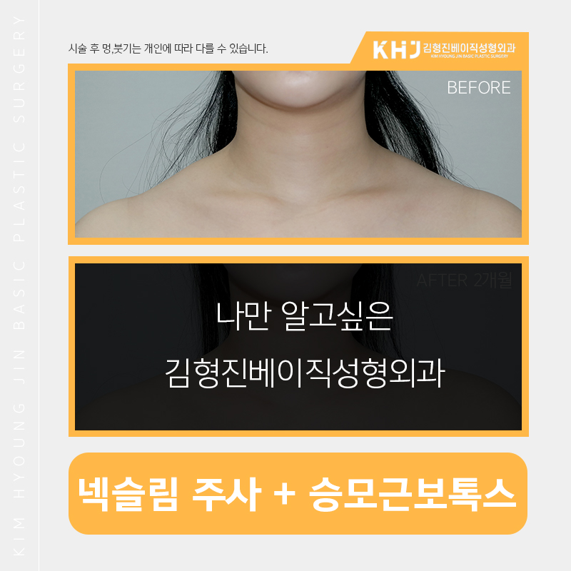 두꺼운목 해결은 넥슬림주사로 관련 이미지 2