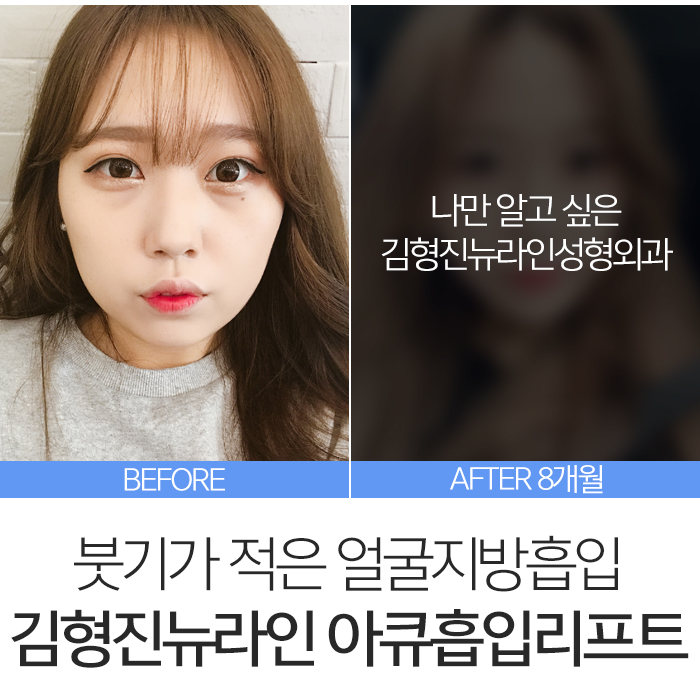 아큐스컬프 붓기 때문에 고민? 관련 이미지 3