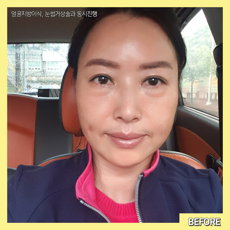 중년눈밑성형 아직도 고민하신다면 관련 이미지 3
