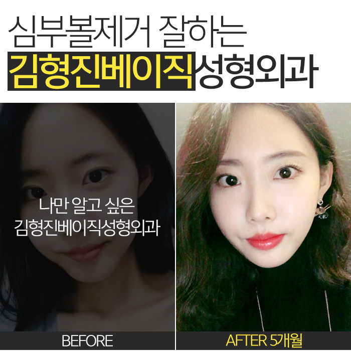 불독살 제거는 이 방법 뿐★ 관련 이미지 8