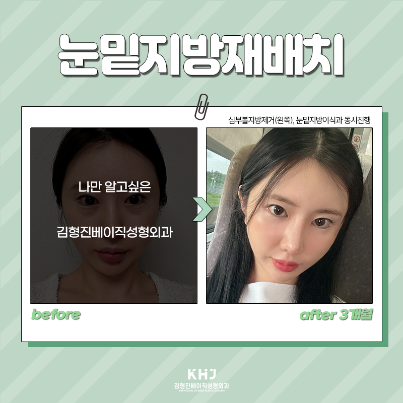눈밑지방재배치전후 보고 가세요! 관련 이미지 6