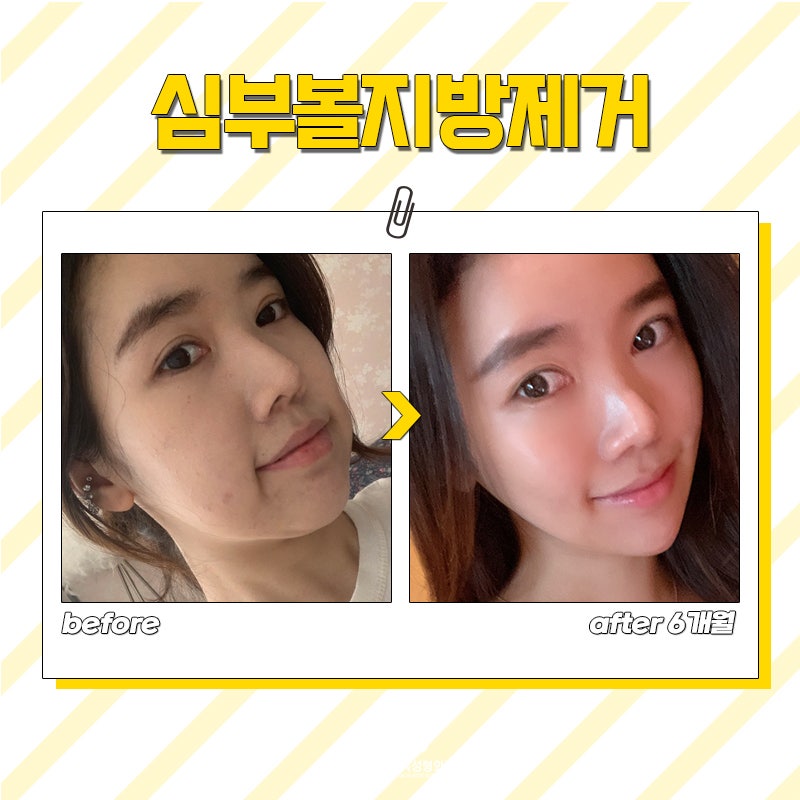 역대급 심부볼지방제거후기! 잃어버린 V라인 되찾았어요 관련 이미지 5