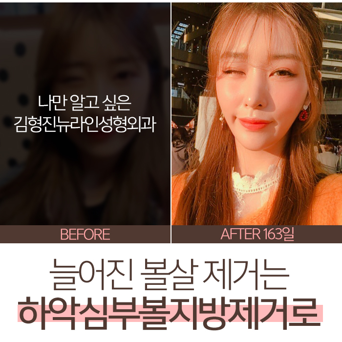 늘어진볼살 제거하는법이 궁금해? 관련 이미지 8