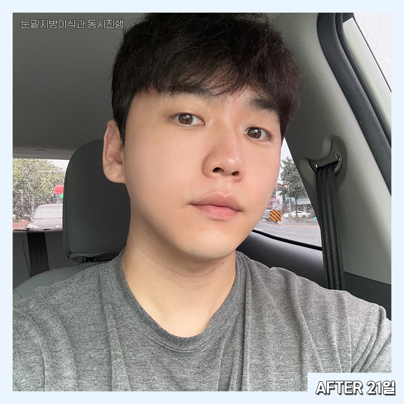 눈밑지방재배치변화과정 한눈에 확인하고 가세요! 관련 이미지 7