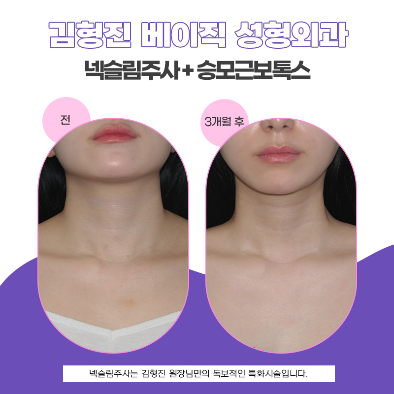 목이 짧고 두꺼워 보인다면 넥슬림주사가 답이에요 관련 이미지 4
