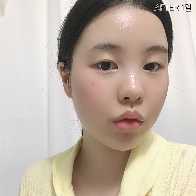 심부볼제거술, 확실한 볼살제거 방법 관련 이미지 3