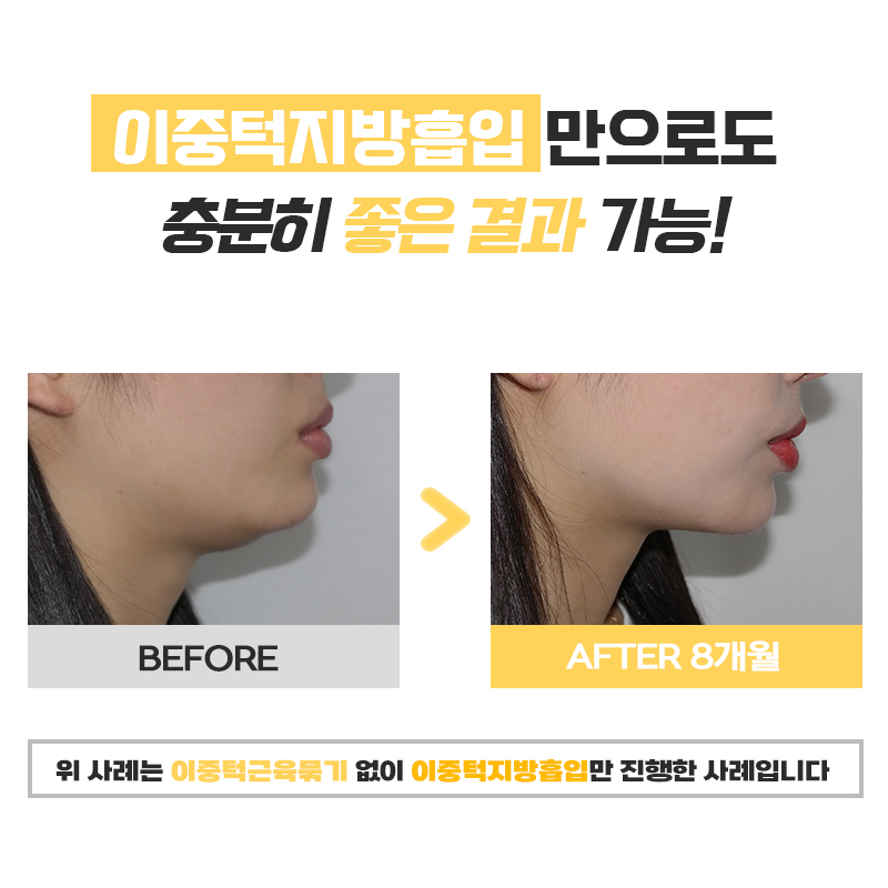 턱살지방흡입에 대해 솔직하게 다 알려드릴게요 관련 이미지 6