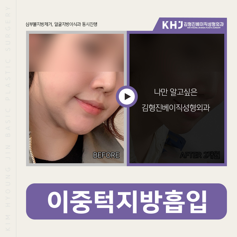 이중턱지방흡입흉터 안 보여요! 관련 이미지 3