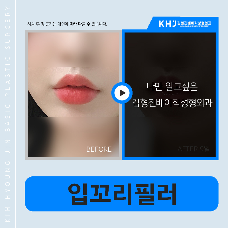 압구정입꼬리필러 전문인 곳에서 고민 해결! 관련 이미지 5