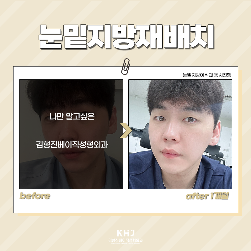 눈밑지방재배치회복기간 빠를 수밖에 없는 이유! 관련 이미지 6