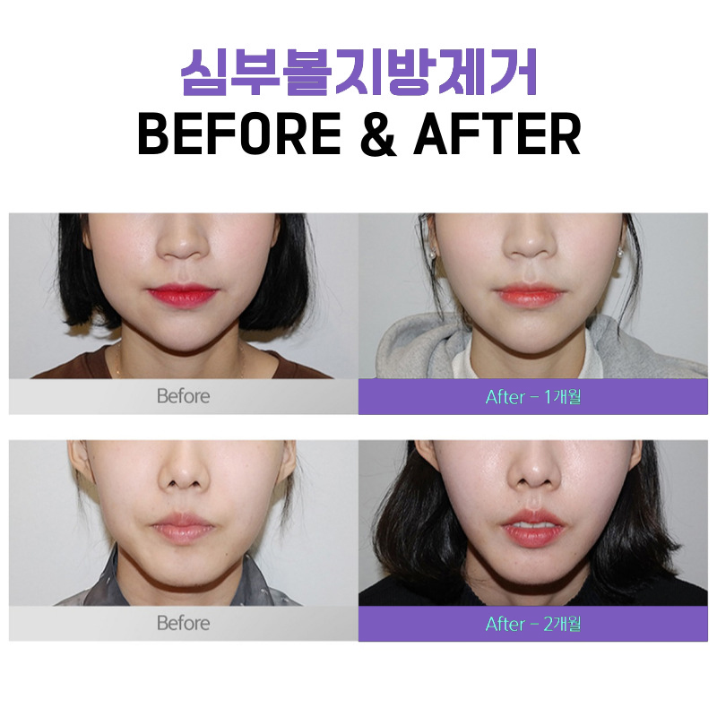 윈터 얼굴형 만들어 준 불독살제거방법 관련 이미지 5