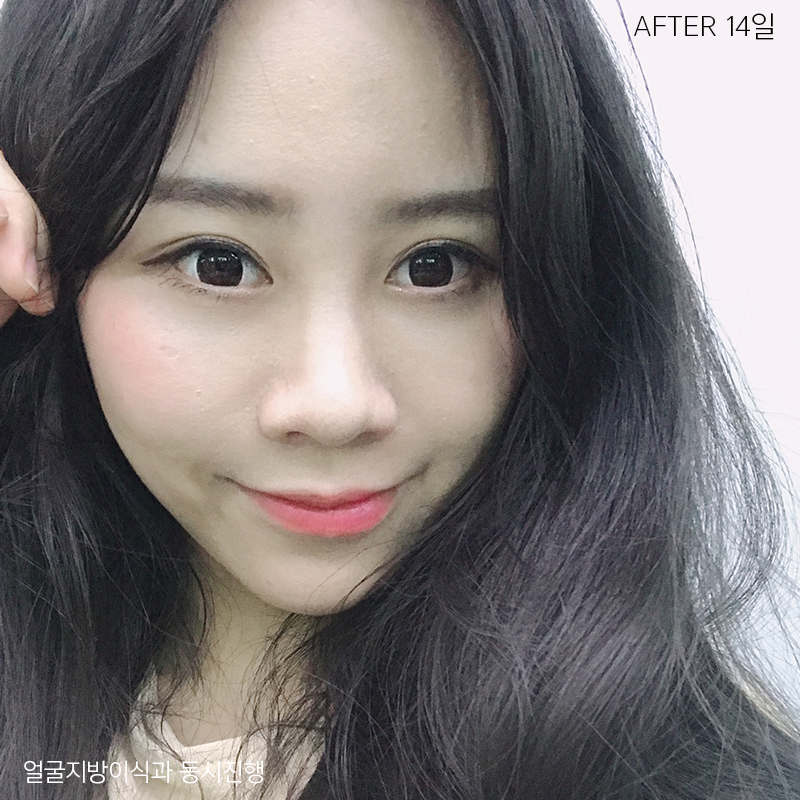 눈밑지방재배치회복과정이 빠를 수밖에 없는 이유 관련 이미지 4