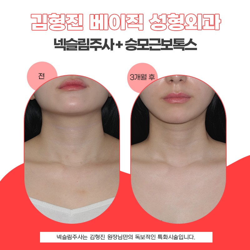 넥슬림주사전후 목부터 어깨까지 더 여리여리하게 관련 이미지 5