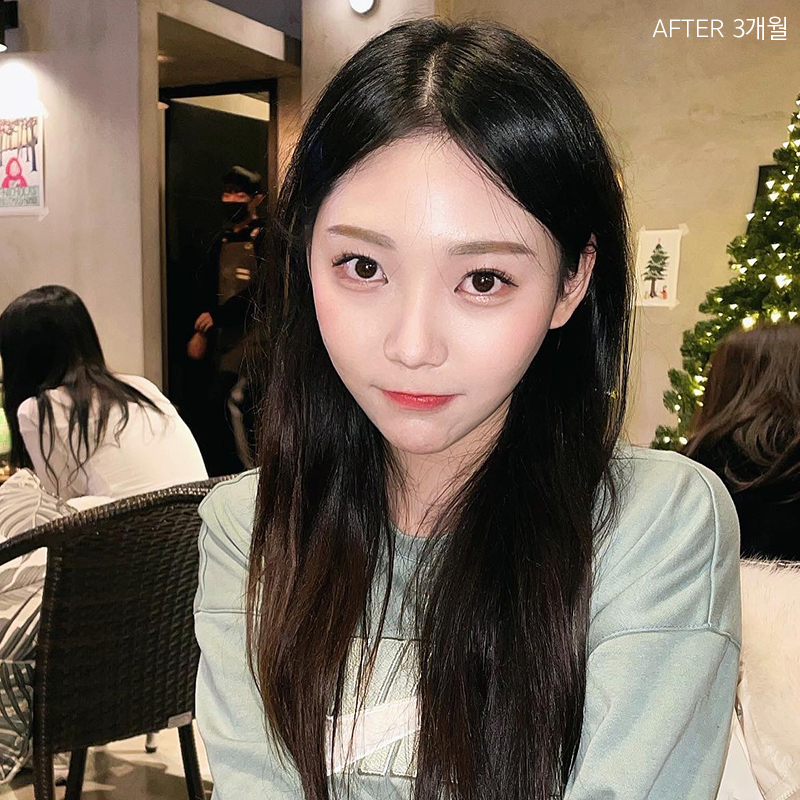 심부볼  보톡스 효과 없었던 건 관련 이미지 6