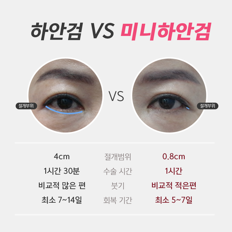 중년눈밑처짐 걱정하지 마세요! 관련 이미지 4