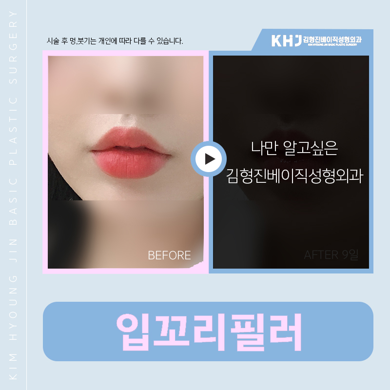 압구정입꼬리필러 잘하는 곳 찾고 있다면 관련 이미지 5
