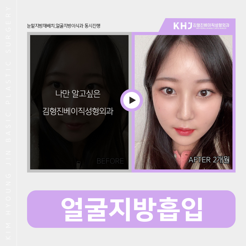 얼굴지방흡입붓기 걱정이시라구요? 관련 이미지 3